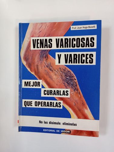 VENAS VARICOSAS Y VARICES. MEJOR CURARLAS QUE OPERARLAS.